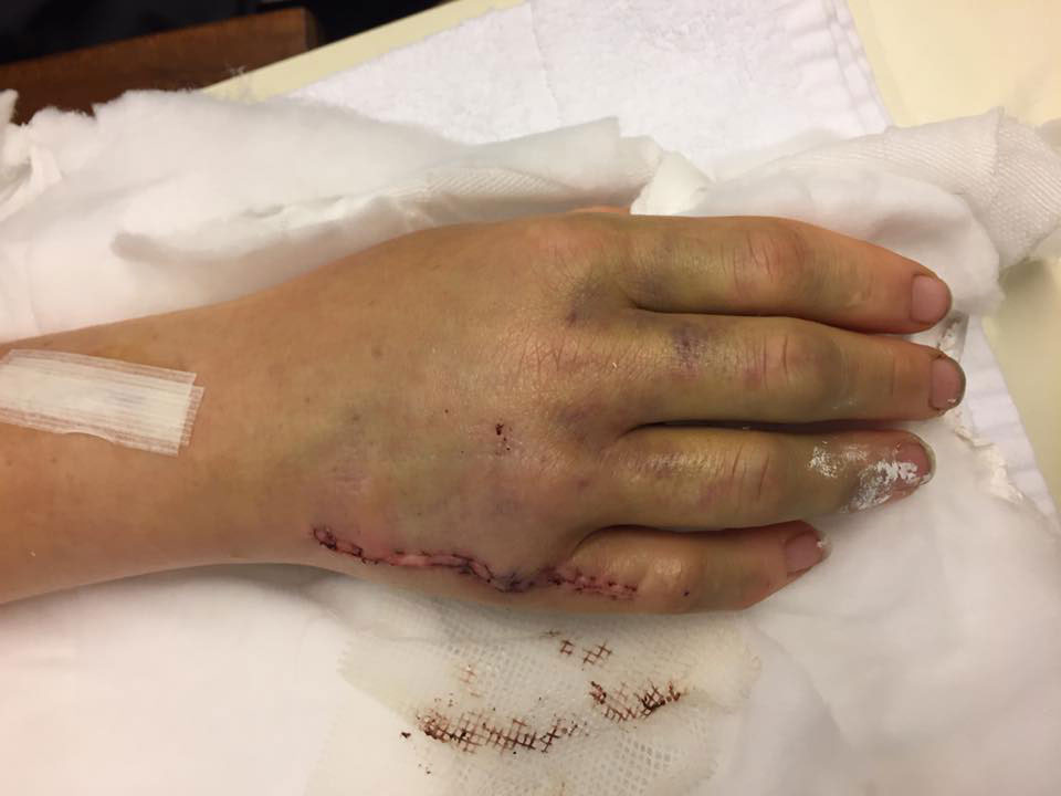 Hand-Surgery