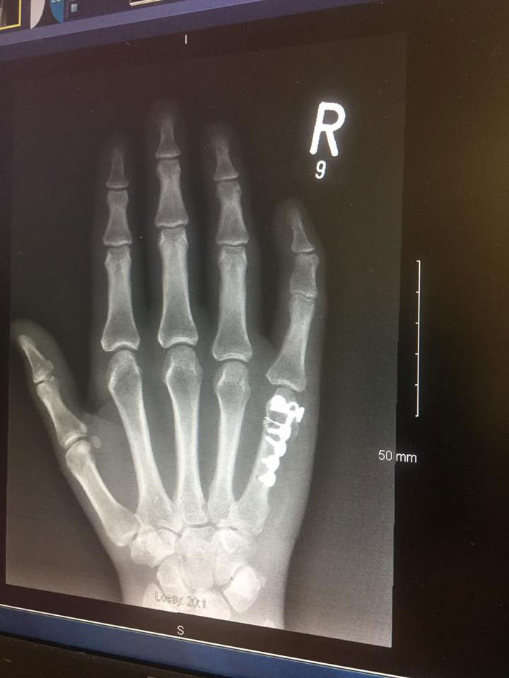 hand-x-ray